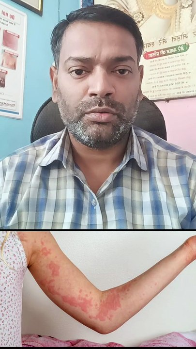 घमौरियों का इलाज ।