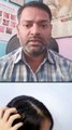 बालों का झड़ना और रूसी का इलाज ।