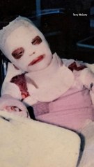 After a Fire Incident Burned 73 Percent of His Skin at Age 6, Man Trains to Become a Firefighter