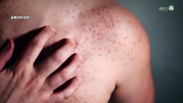 Indagan primera muerte por sarampión en Jalisco; sería una bebé de 11 meses