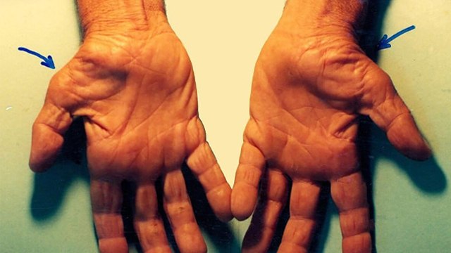 हथेली में दर्द क्यों होता है,इलाज क्या है | Hatheli Me Dard Kyu Hota Hai,Ilaj Kya Hai | Boldsky