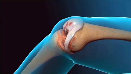 Advanced Total Knee Replacement Surgery in Delhi – Trusted Orthopedic Specialists