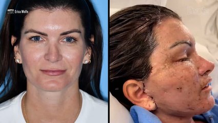Woman Spends $78K on a Facelift. Days Later, She Questions ‘What the F--- Did I Do?’ (Exclusive)