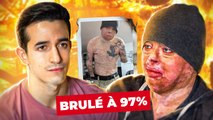 Brûlé à 97% : il raconte son terrible accident (le plus grand brûlé au monde)