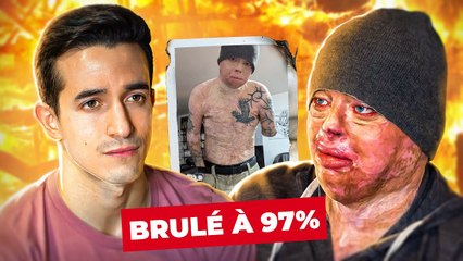 Brûlé à 97% : il raconte son terrible accident (le plus grand brûlé au monde)