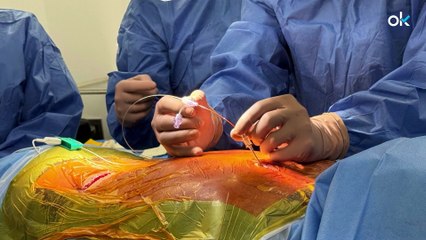 La neuroestimulación permite recuperar la movilidad en un paciente con síndrome de dolor regional complejo