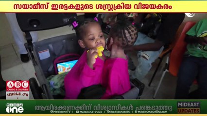 റിയാദിൽ ജമൈക്കൻ സയാമീസ് ഇരട്ടകളുടെ വേർപെടുത്തൽ വിജയകരം