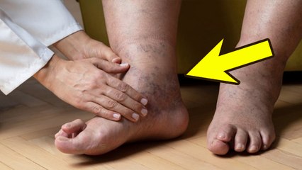 डायबिटीज में पैरों का कालापन कैसे दूर करें | Diabetes Me Pairo Ka Kalapan kaise Thik Kare ?