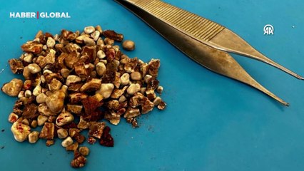 Doktorlar şoke oldu, hastanın böbreklerinden 300'ün üzerinde taş çıktı