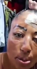 Mujer contó cómo su rostro terminó desfigurado
