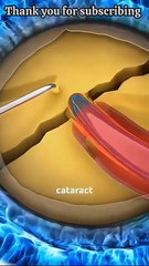 How Cataract Surgery Works _ Step-By-Step Animation Explained#science #knowledge #education #medical