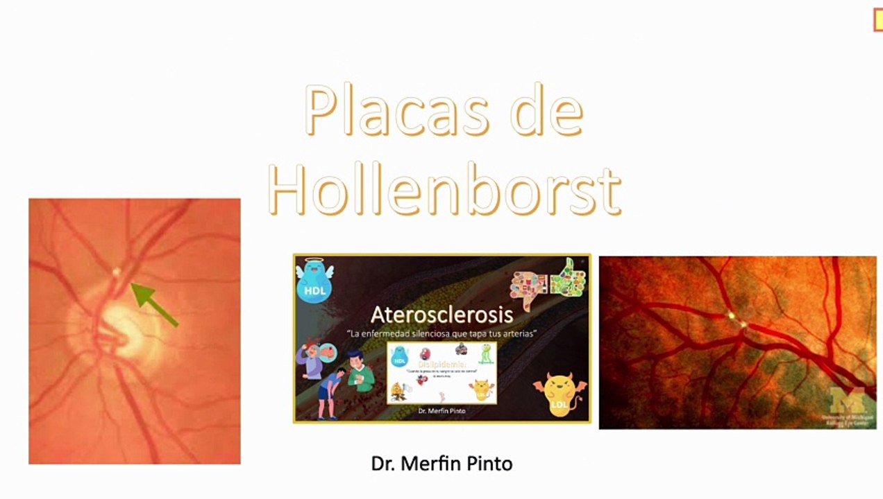 Placas de Hollenborst #elcuerpoymas #salud #medicina #Hollenborst #PlacasdeHollenborst