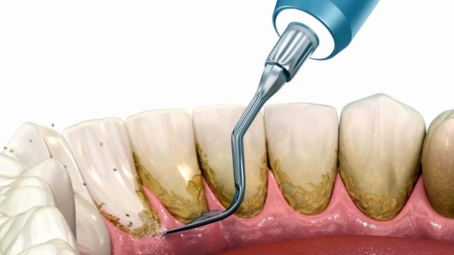 What Happens if You Skip Dental Scaling and Cleaning? | Best Dental Clinic in Bhiwani | Triveni Dental