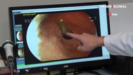 Başörtüsünü bağlarken hapşırınca ağzındaki iğneyi yuttu