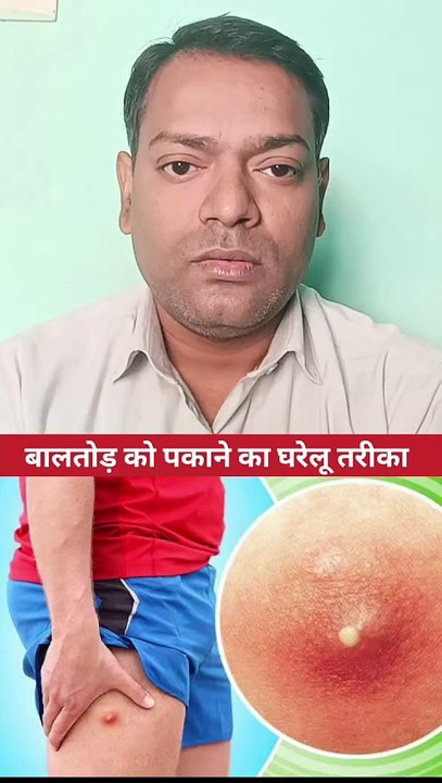 बालतोड़ को पकाने का घरेलू तरीका ।