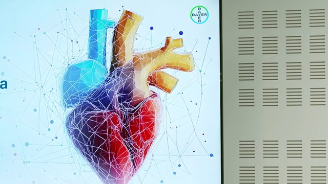 Expertos analizan los avances y retos en el manejo de la amiloidosis cardiaca por transtiretina