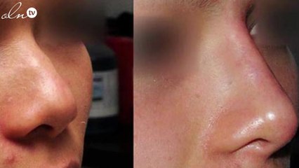 وأخيراً، تجميل الأنف وازالة التجاعيد بدون جراحة