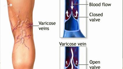 الدكتورة زينة كنيعو تخلصوا من الدوالي الوريدية بدون جراحة!