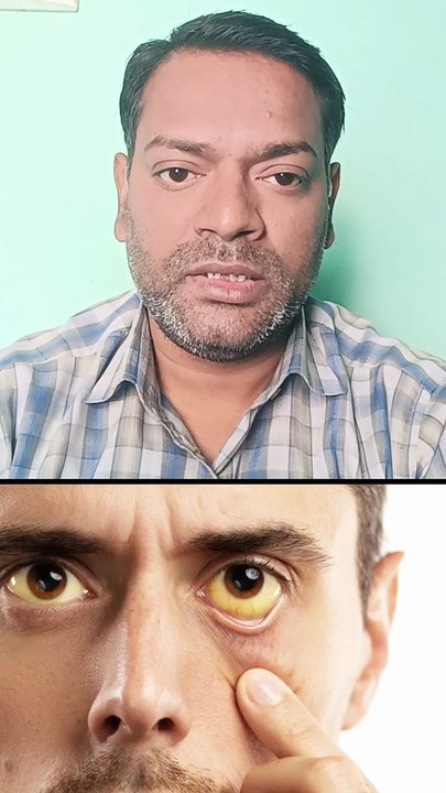 क्या हेपेटाइटिस सी की बीमारी ठीक हो सकती है ।