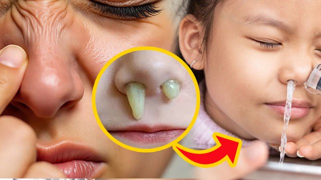 Nose Cleaning Home Remedy: नाक की गंदगी को कैसे साफ करें?, Ghar Par Naak Saaf Karne Ka Tarika...