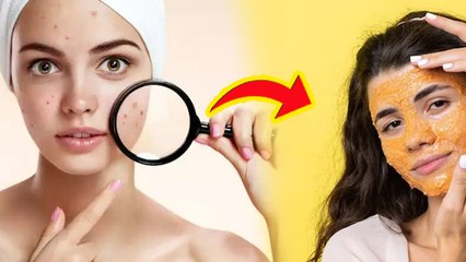 Dark Spot Treatment Home Remedy:Dark Spots Kaise Theek Karen| 3 दिन में काले दाग कैसे हटाए| Boldsky