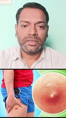 फोड़ा,फुंसी,बालतोड़