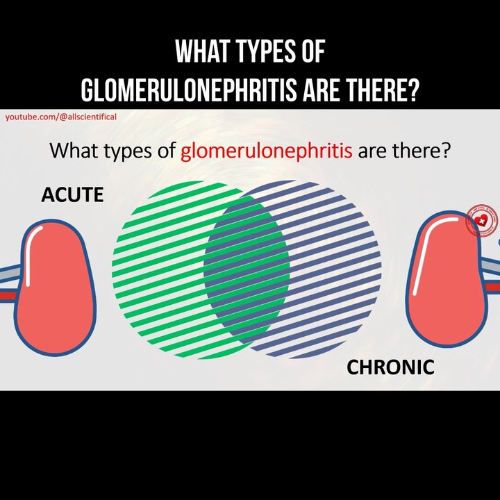 What types of glomerulonephritis are there?