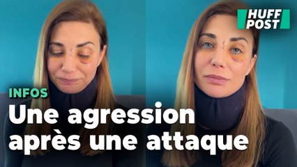 Ariane Brodier s’exprime après avoir subi une grave agression, trois jours après qu’un chien l’a attaquée