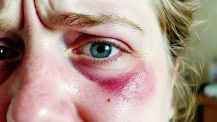 Acne | Causes and symptoms | Health | itsmehvish