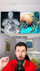 Voici des choses bizarre retrouvées dans le corps humain.
