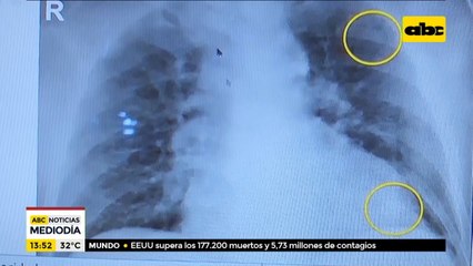 ¿Cómo avanza el coronavirus en los pulmones?
