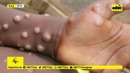 Confirman segundo caso de viruela del mono en Paraguay