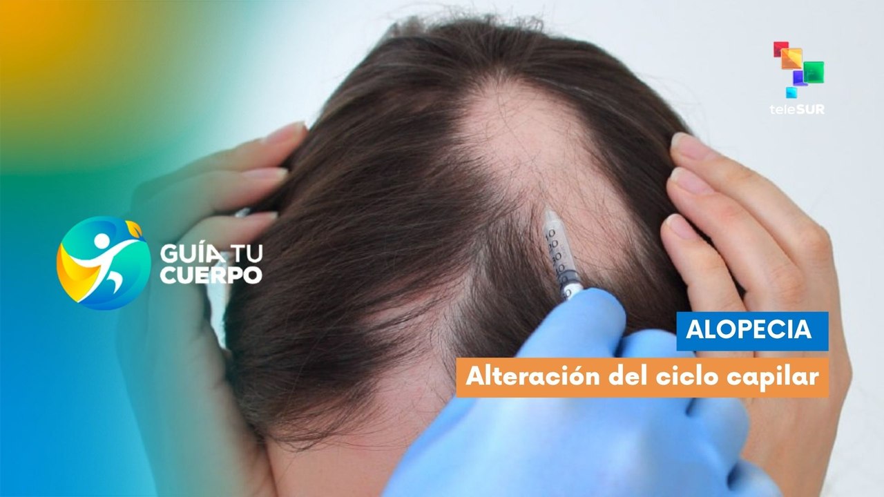 Alopecia: Alteración del ciclo capilar