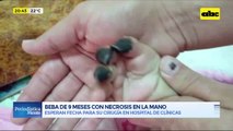 Video: Beba de 9 meses con necrosis en la mano