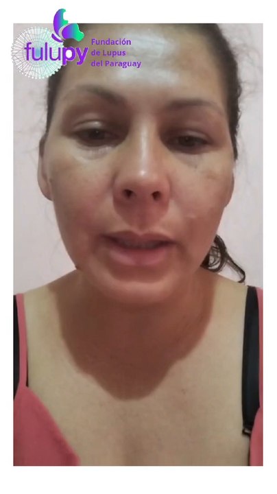 Rumilda Enciso Madre De Una Niña Con Lupus Clama Medicamentos Al Presidente De La República Santiago Peña