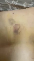 Varios Golpes En El Cuerpo De Víctima