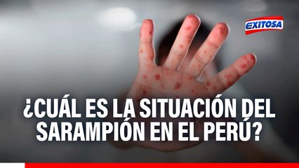 ¿Cuál es la situación del sarampión en el Perú? Esto dice el Ministerio de Salud