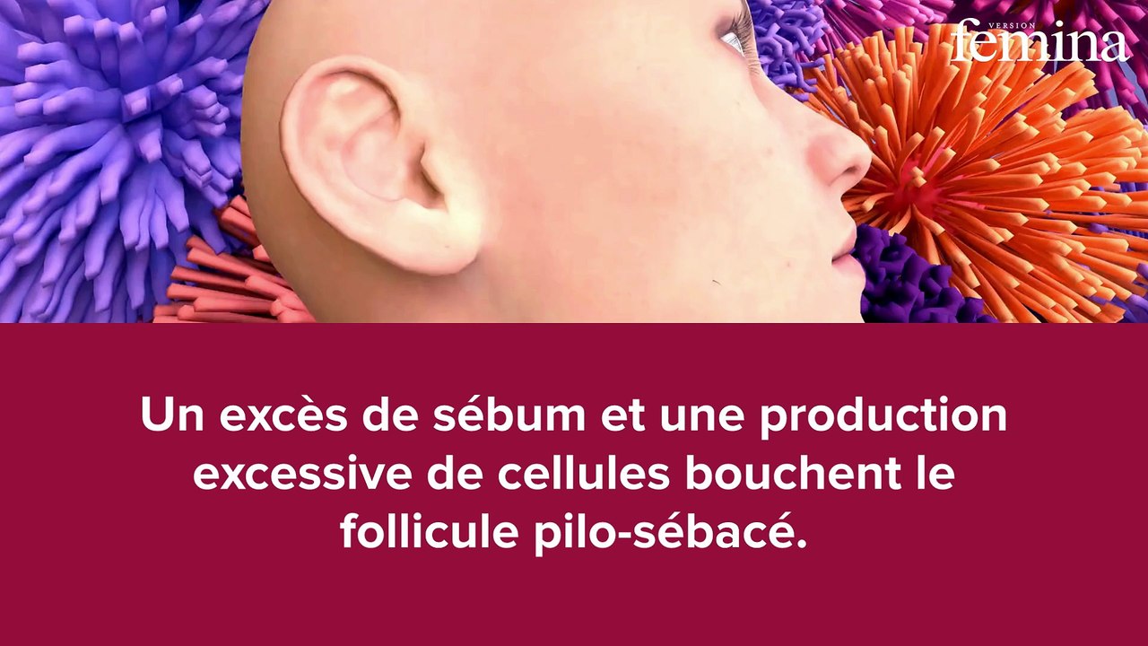 Des boutons sur le front cet hiver ? Vous tenez peut-être le coupable entre vos mains