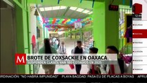 Brote de Coxsackie en Oaxaca: suspenden clases; suman 180 contagios en 2025