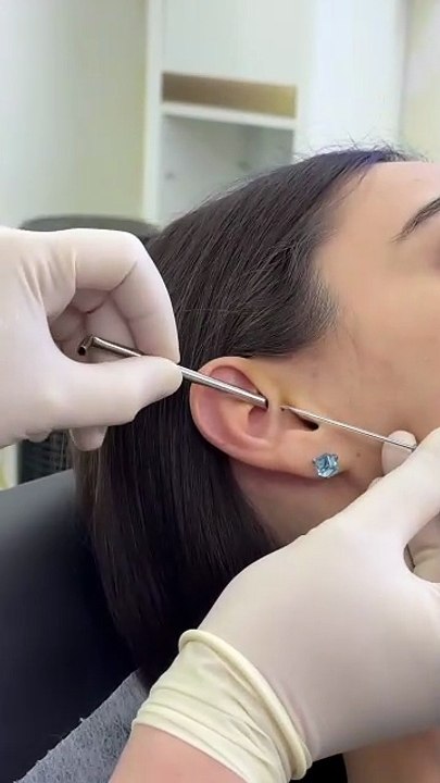 The Daith Piercing: Procedure, Healing, & Aftercare Guide #daithpiercing #earpiercing #helixpiercing
