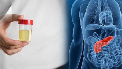 Pancreatic Cancer Symptoms: पीला पेशाब होने का कारण, पैंक्रियाज कैंसर के लक्षण, Yellow Urine Means..