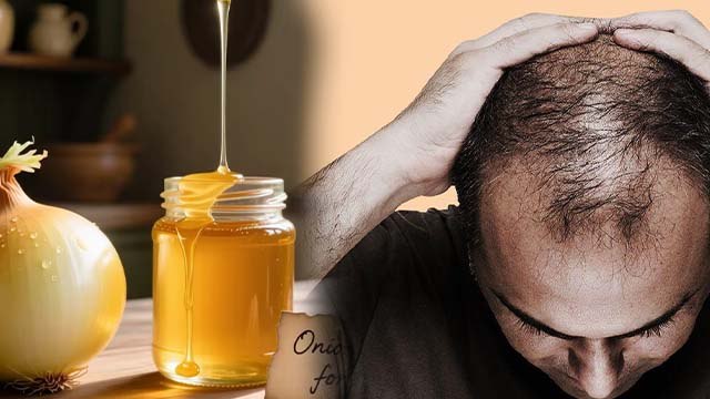Honey & Onion Benefits: बालों में शहद और प्याज का रस लगाने के जबरदस्त फायदे | Boldsky