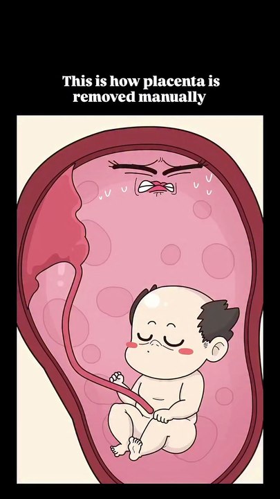 When Nature Needs a Helping Hand _._._ In rare cases_ when the placenta does not detach naturally after childbirth_ doctors may perform manual removal of th(
