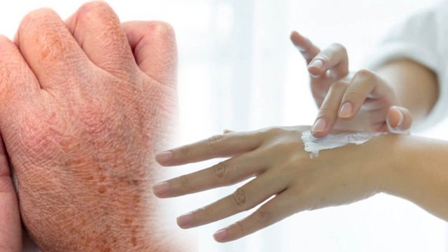 Cracked Hands In Winter: Sardiyo Me Hath Fat Jaye To Kya Kare, सर्दियों में हाथ फटने का इलाज