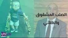 الصلب المشقوق والمشي