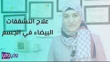 علاج التشققات البيضاء في الجسم