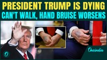 Trump Dying Slowly? Hand Bruise and Stair Fumble Raise Concerns About 79 Year Presidents Health