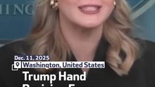 Trump Hand Bruising From ‘Constant’ Hand Shakes
