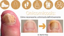 Onicomicosis #elcuerpoymas #salud #medicina #Onicomicosis #Hongosenlasuñas