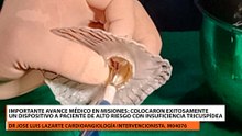 Importante avance médico en Misiones, colocaron exitosamente un dispositivo a paciente de alto riesgo con insuficiencia tricuspídea